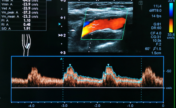 Blood Vessel (Vascular) Ultrasound Imaging - Tomorrow Wellness